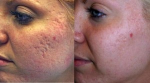 Laserbehandeling acne